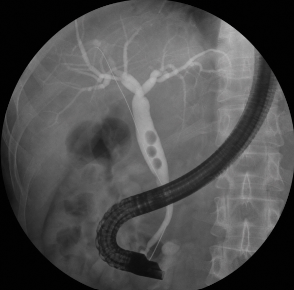 Imagen de referencia de colangiografía con coledocolitiasis